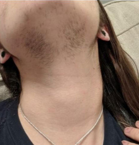 how to remove facial hair naturally at home